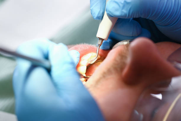 Best Emergency Dental Care for Sports Injuries in Fort Dick, CA